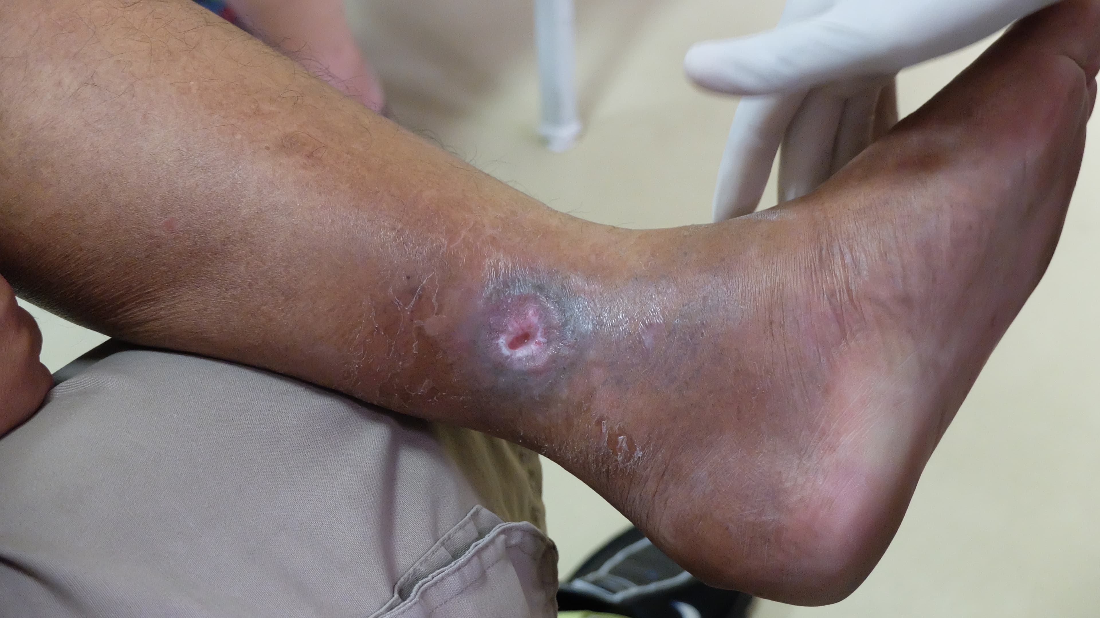 Venous Ulcerations