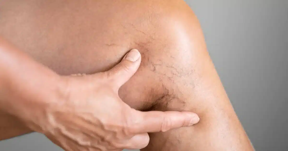 What Types of Vein Issues Can be Addressed with Sclerotherapy?