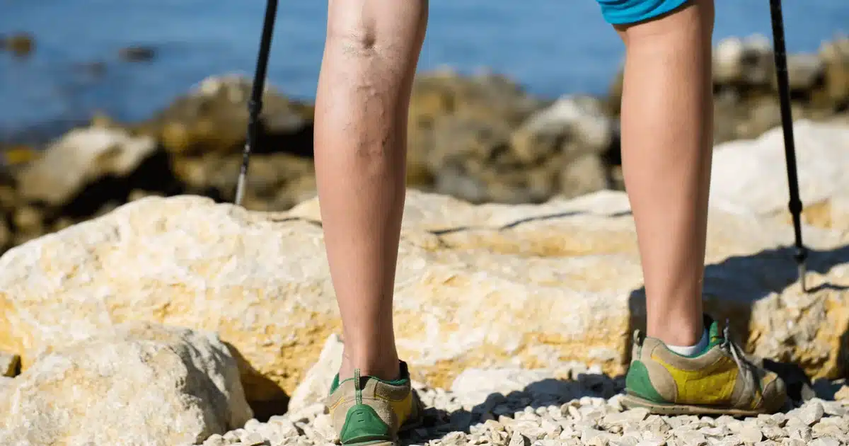 Can Spider Veins be Prevented?