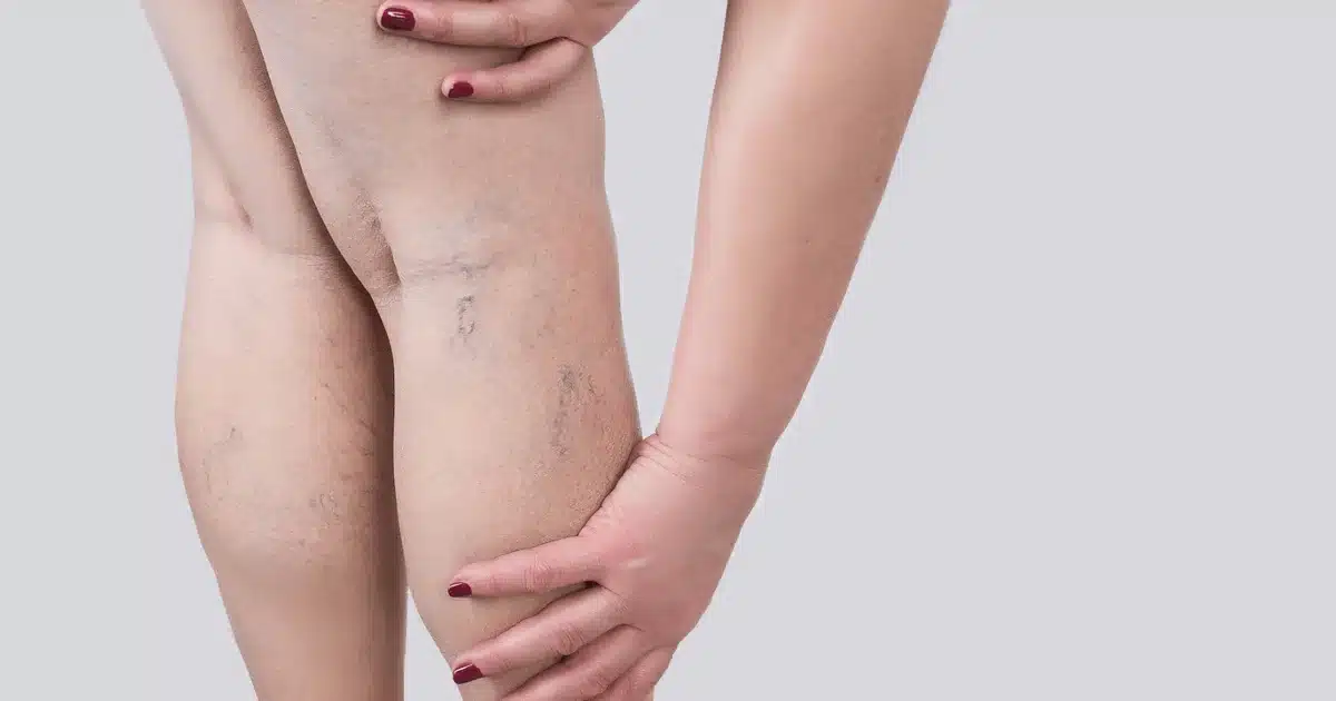 Who Is at Risk of Developing Varicose Veins?