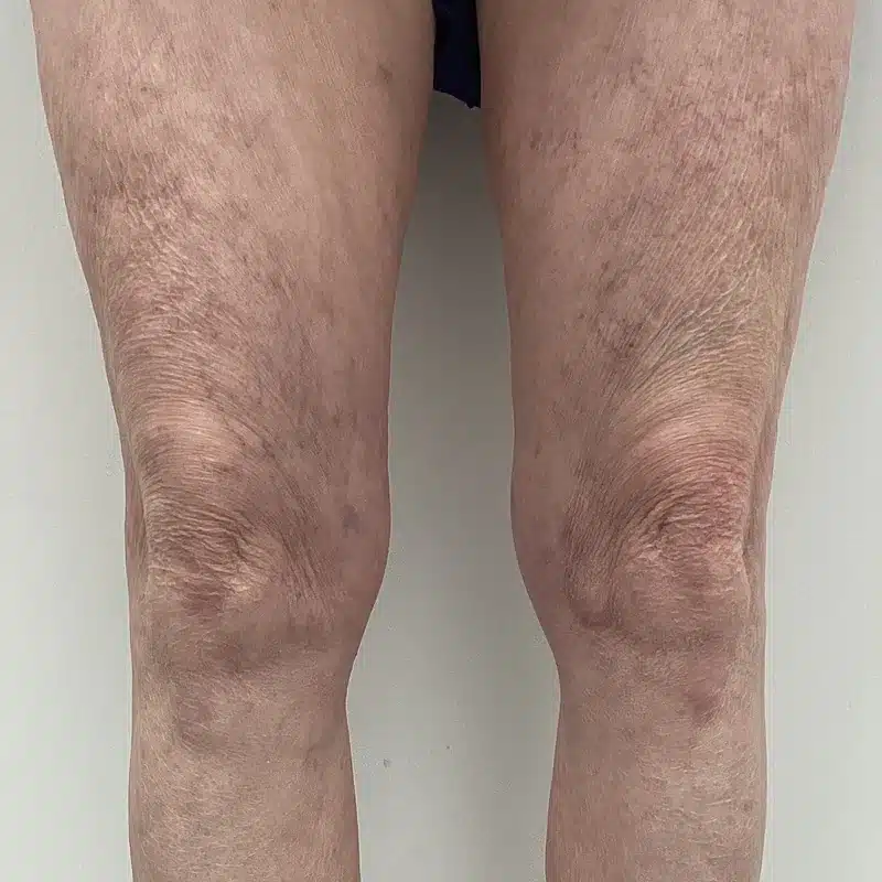 After Treatment