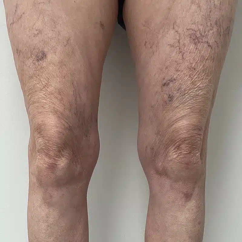 Before Treatment