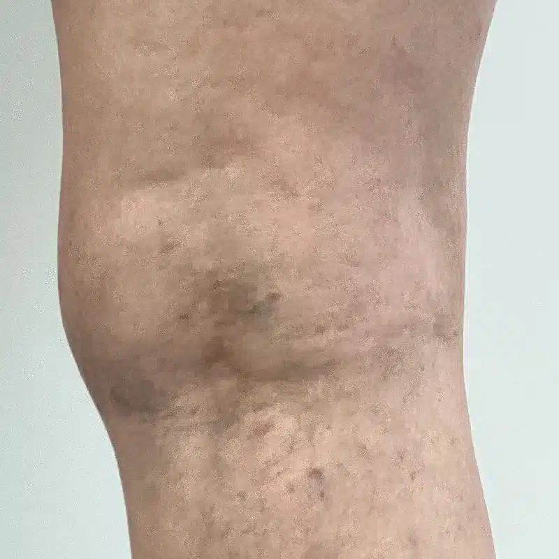 After Treatment