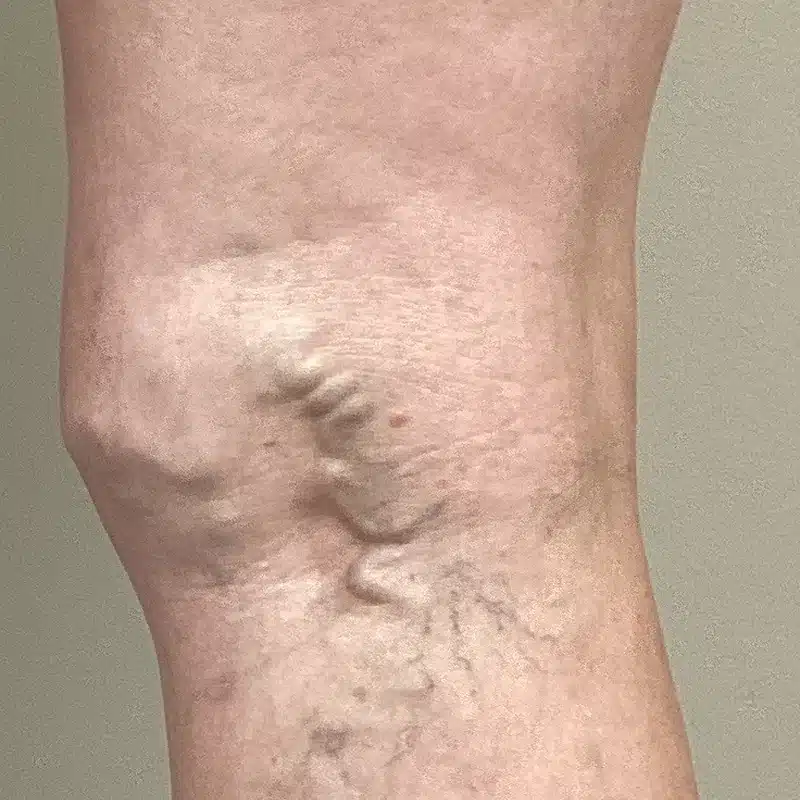 Before Treatment