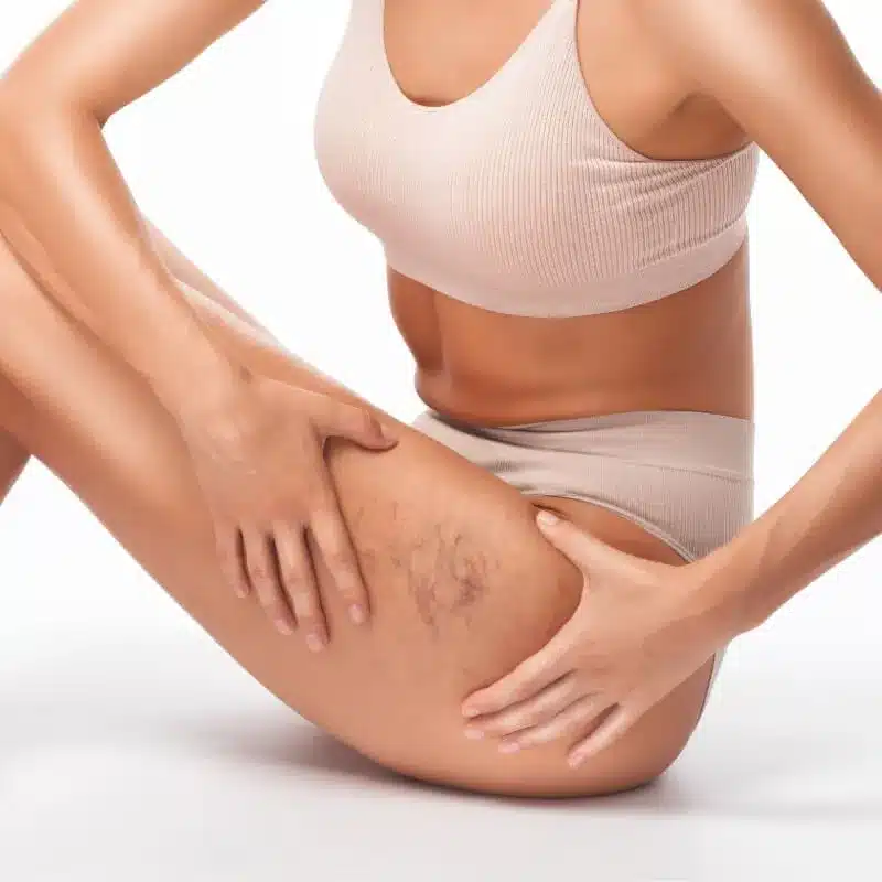 Spider Veins