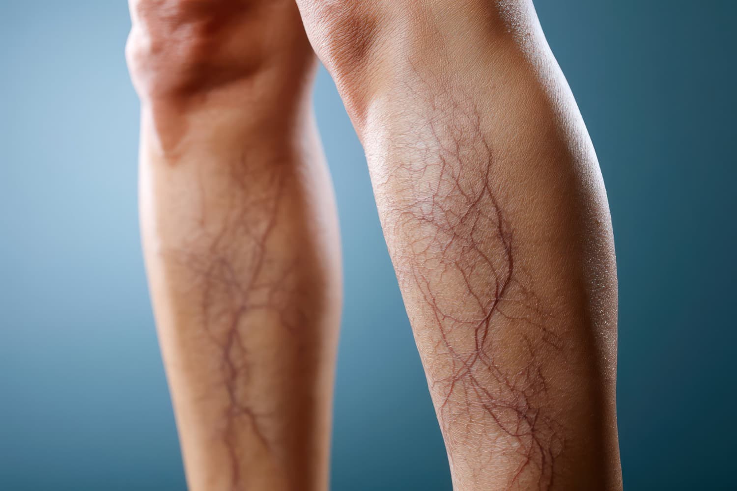 Leg Veins