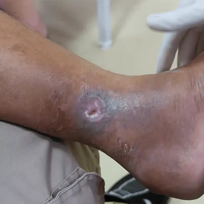 Venous Ulcerations